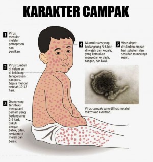 Penderita Campak Meningkat di Tanjabtim   